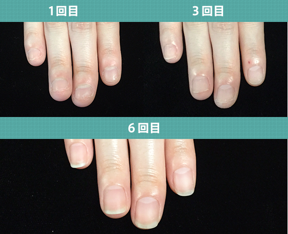 アクリル深爪矯正法
