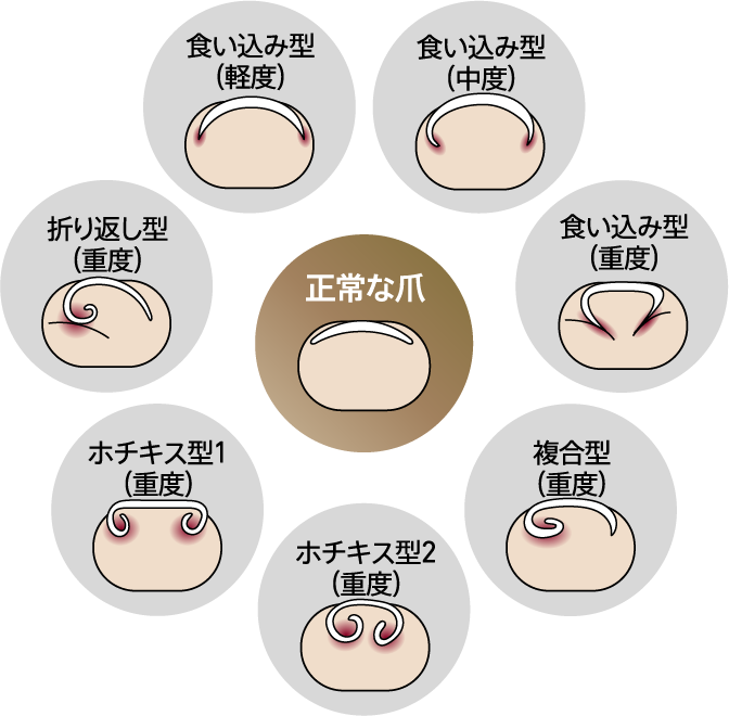 巻き爪の種類